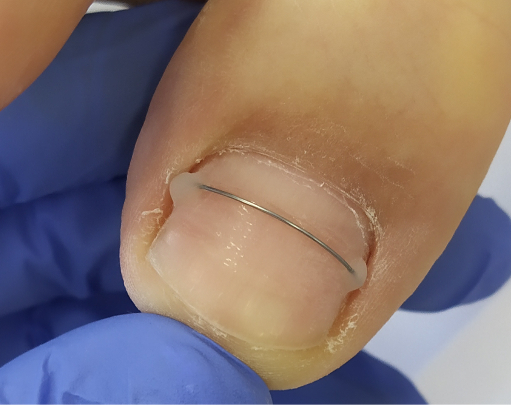 Установка Титановой нити