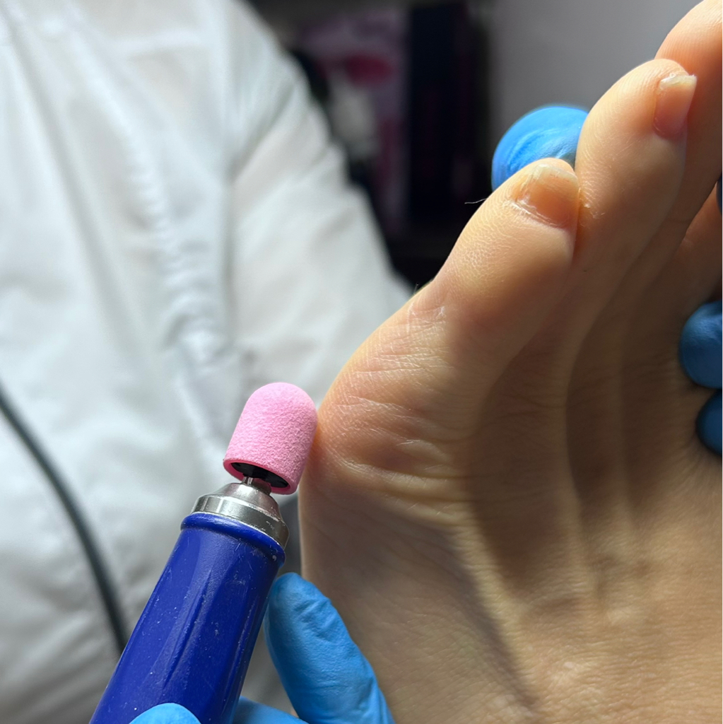 Обработка мозоли