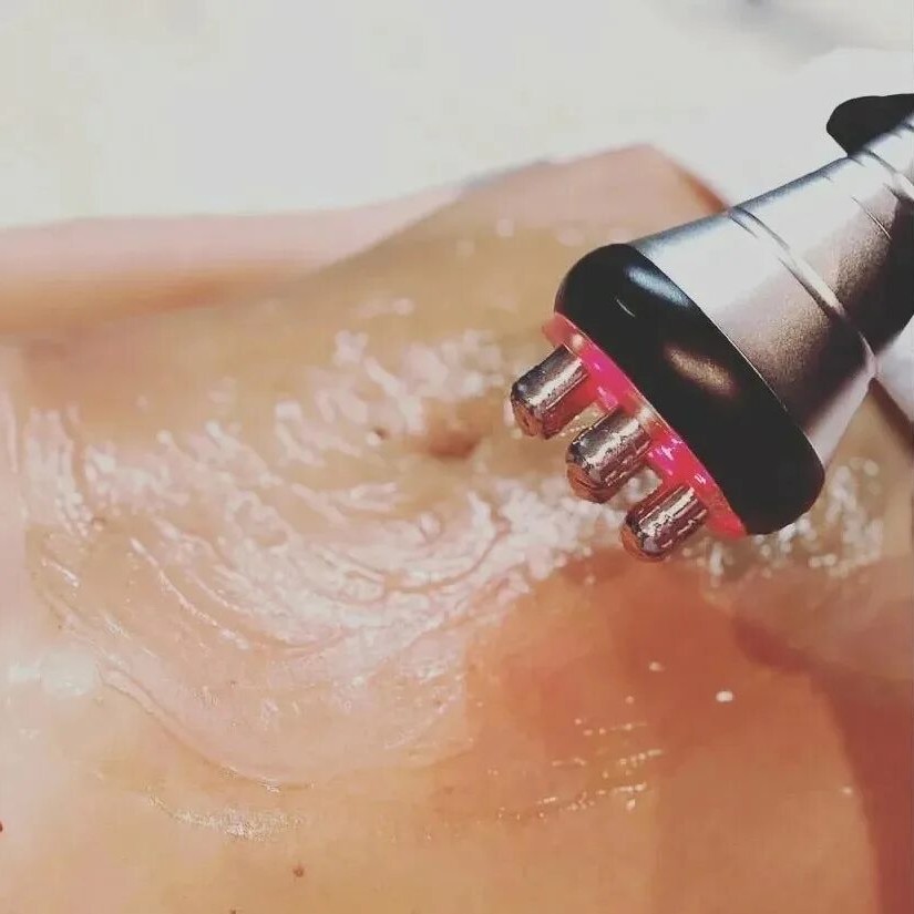 Радиочастотная процедура подтяжки кожи (RF)