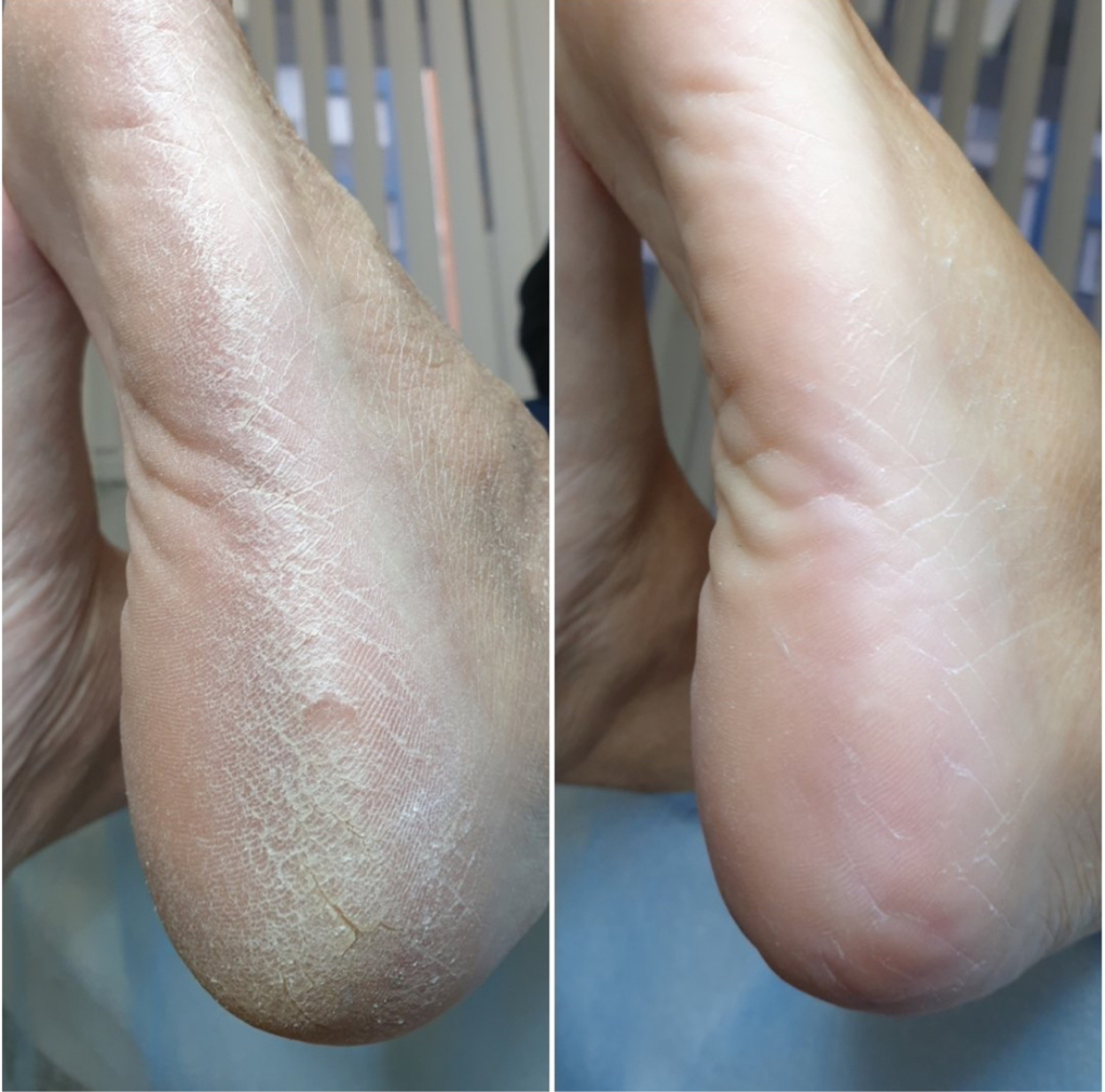 Удаление трещин