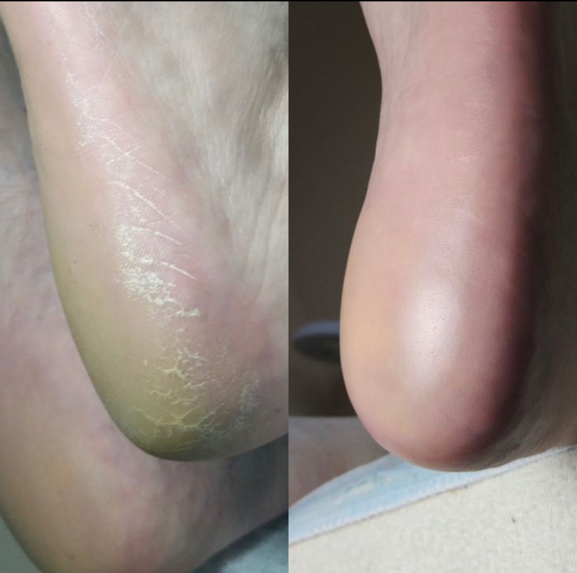 Обработка стопы Smart