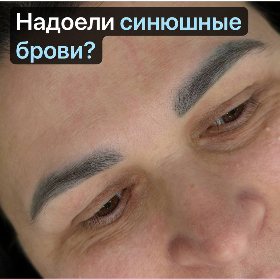Лазерое удаление татуажа