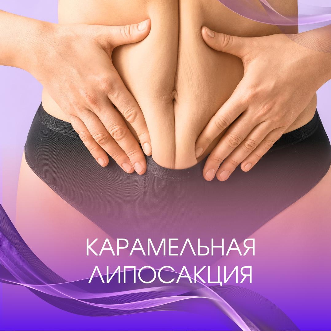 Карамельная липосакция