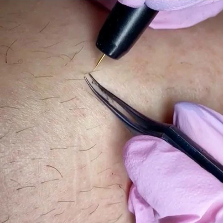 Электроэпиляция бикини