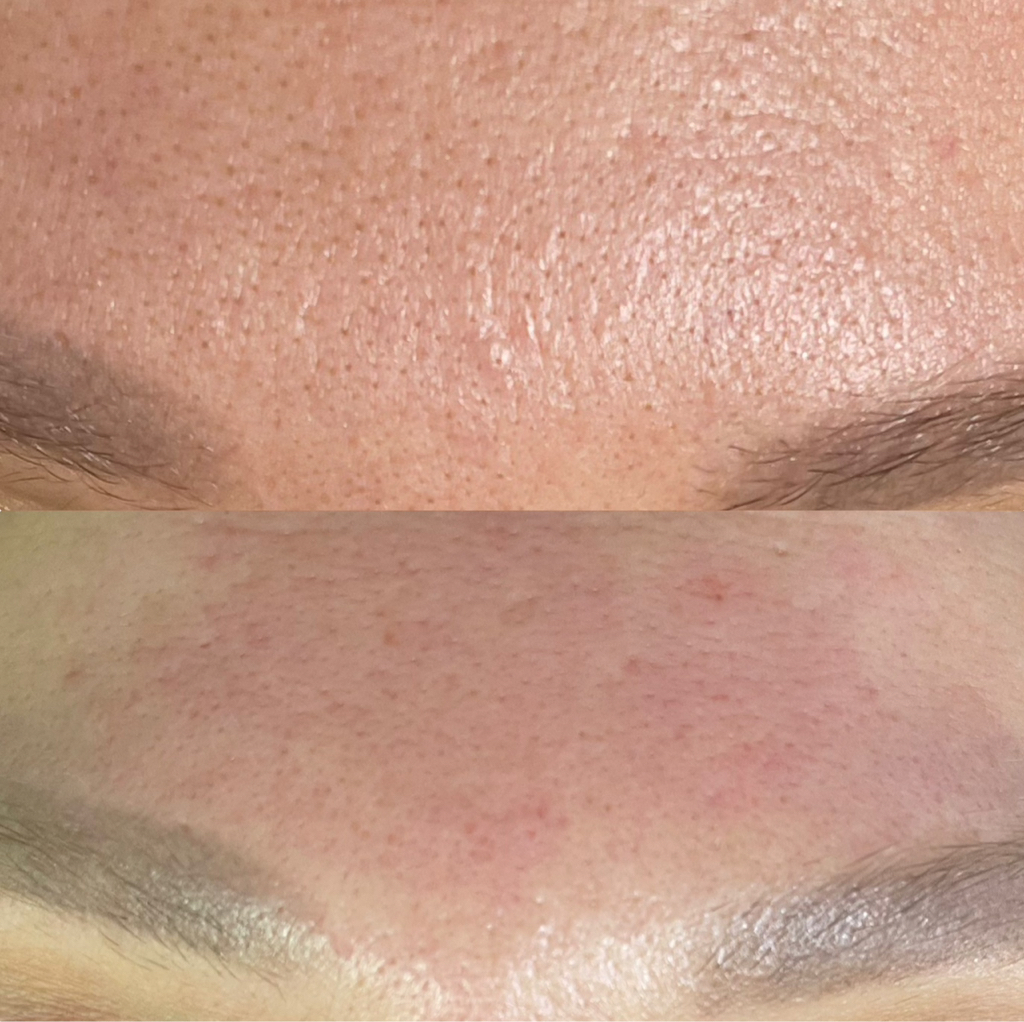 Ультразвуковая Чистка Лица