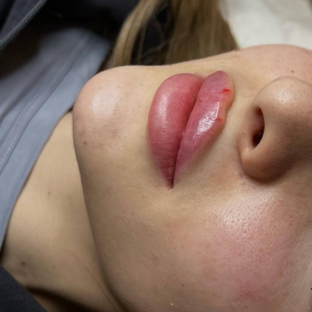 aumento de labios rusian lips, oferta temporal