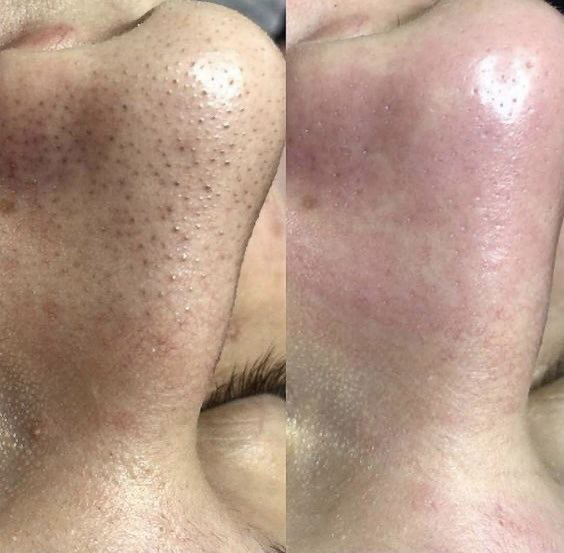 Механическая чистка лица