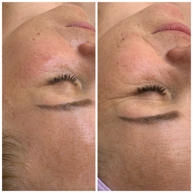 Омолаживающий массаж лица