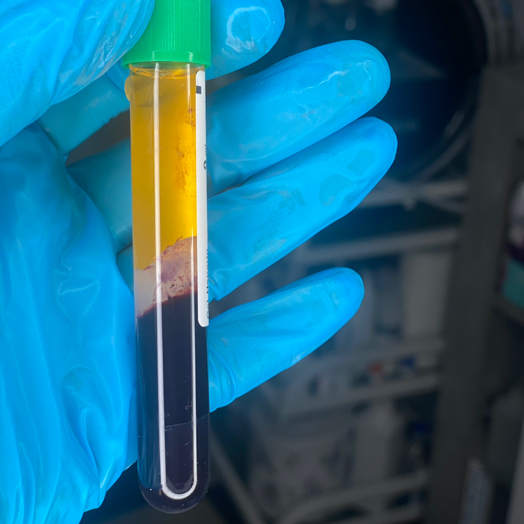 Плазмолифтинг