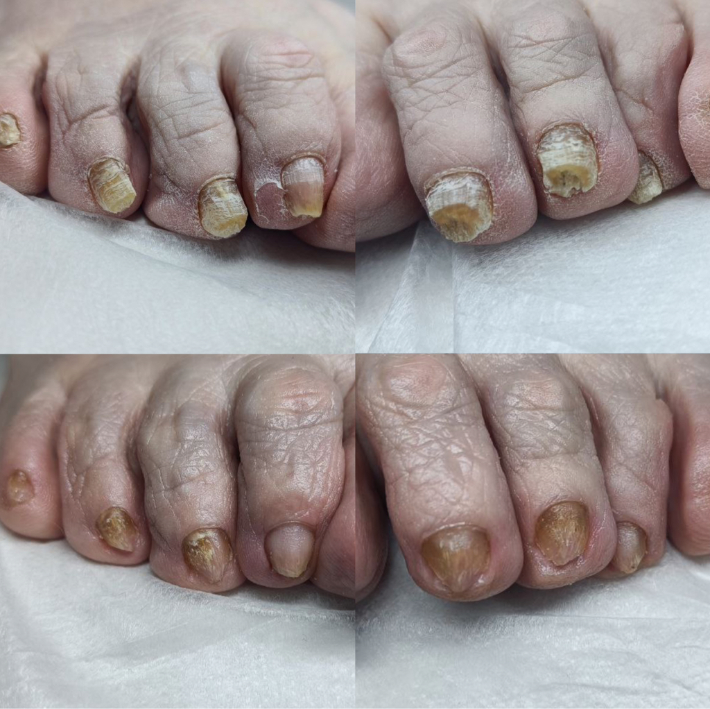 Педикюр подологический (3 степени)