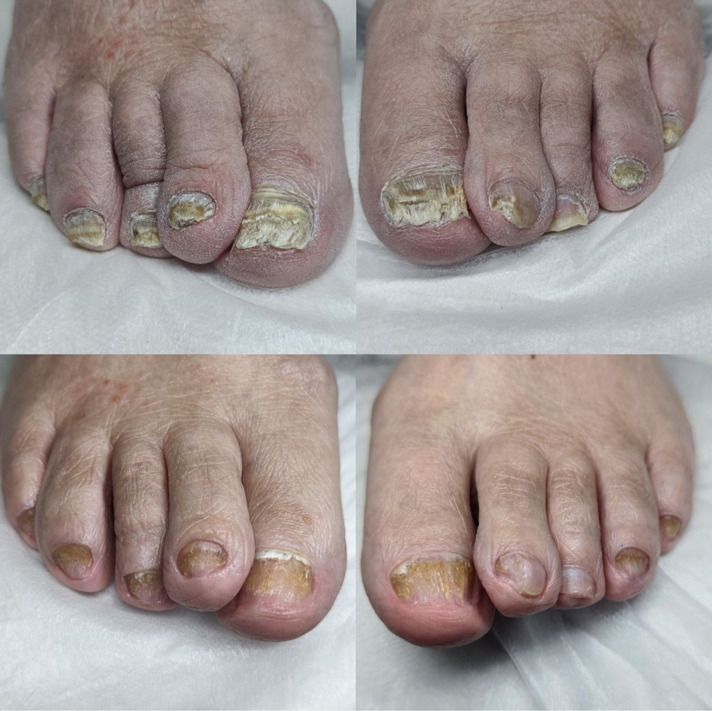 Педикюр подологический (2 степени)