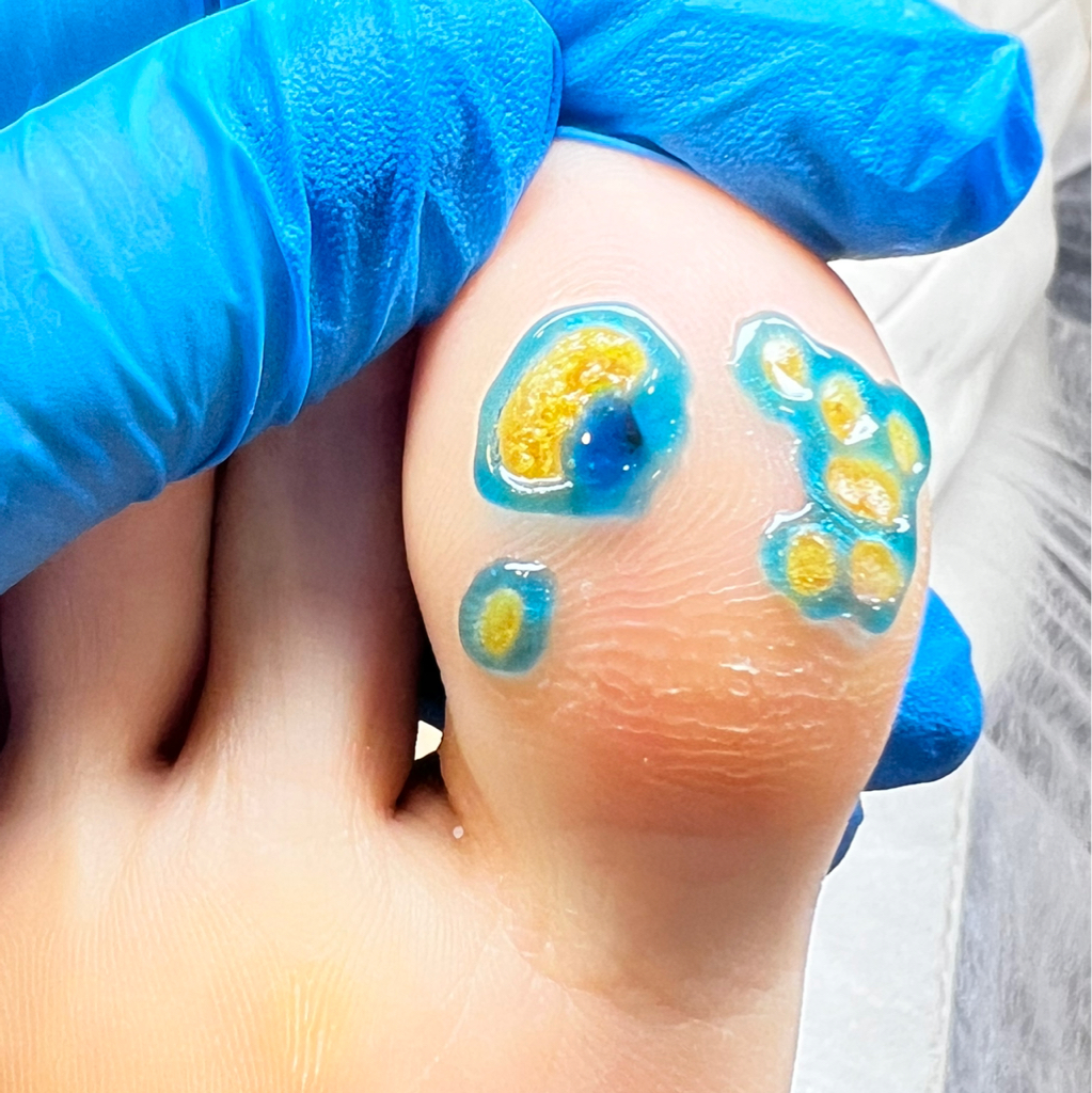 Бородавки до 10 шт ПЕРВИЧНО