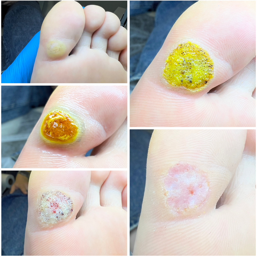 Бородавки до 10 шт ПОВТОРНО