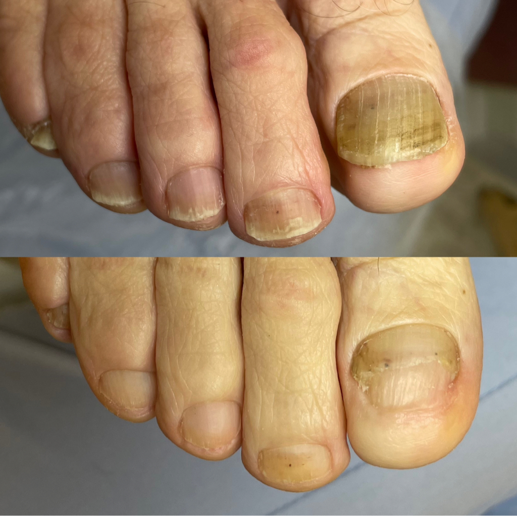 Подологический педикюр