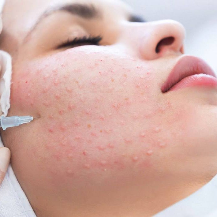 Биоревитализация