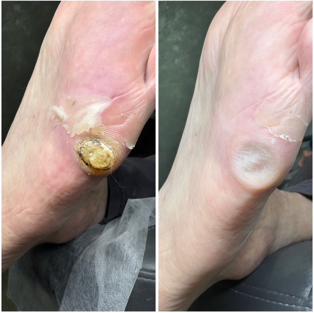 Обработка мозоли (за единицу)