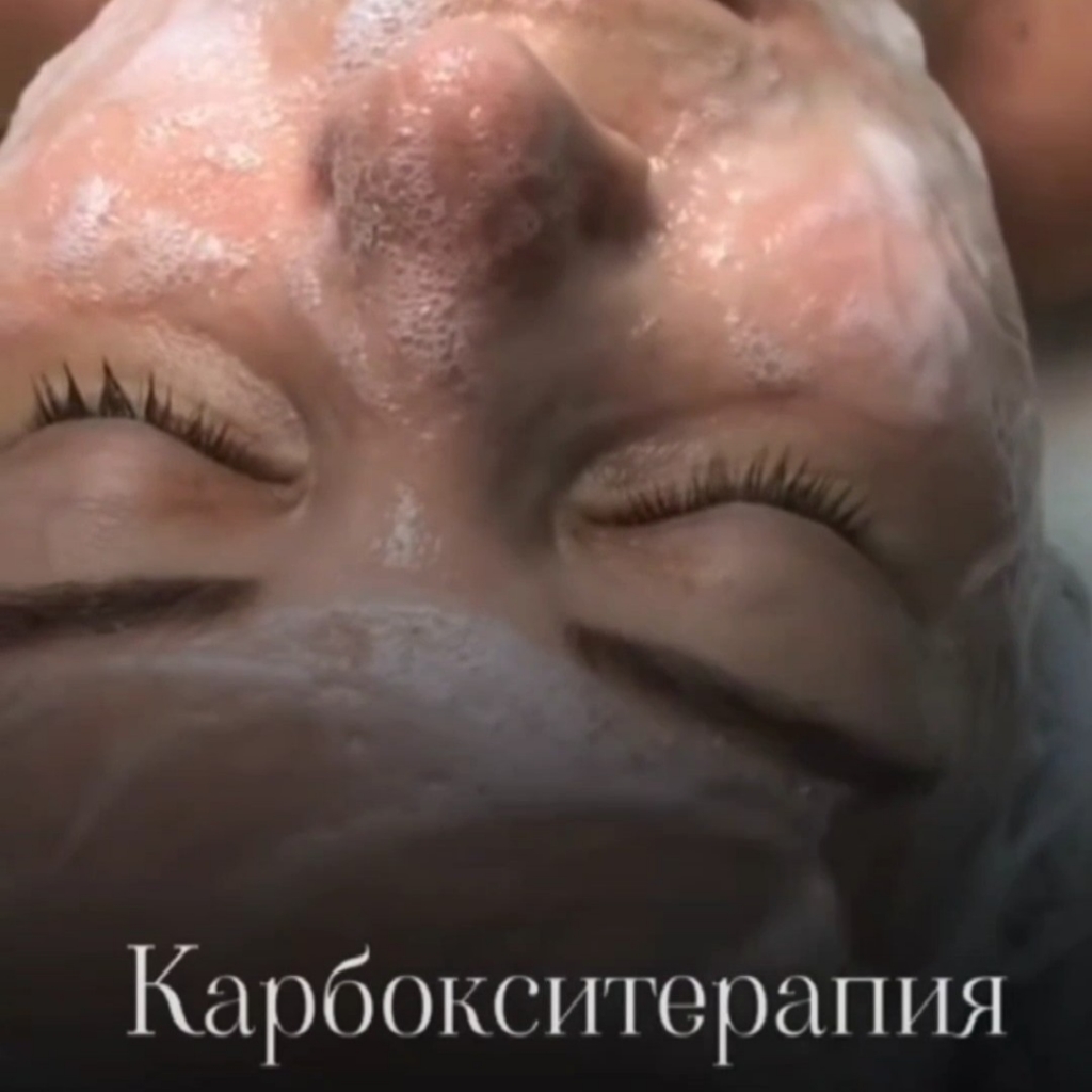 Карбокси терапия 1 процедура