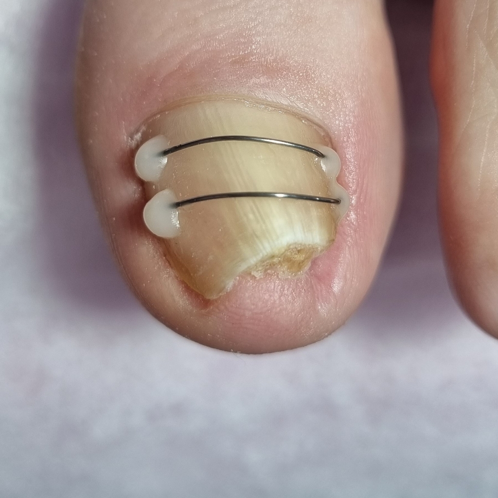 Установка коррекционной системы вростающего ногтя