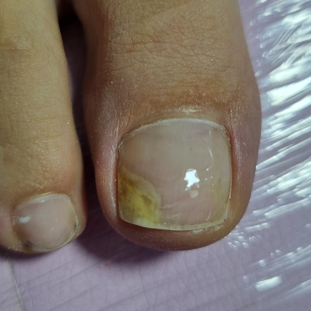 Зачистка онихолизиса 1 ногтя