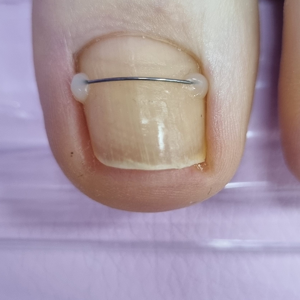 Переустановка коррекционной системы вростающего ногтя