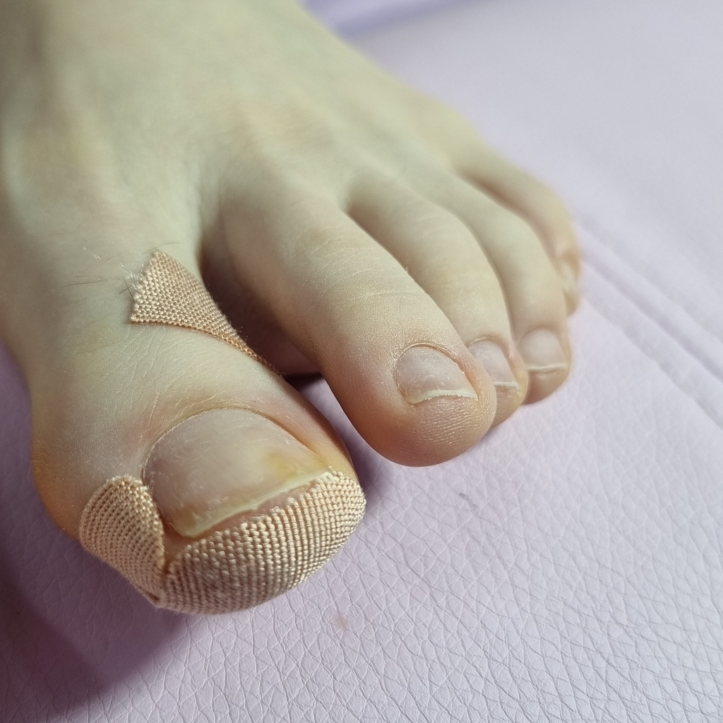 Тейпирование 1 ногтя