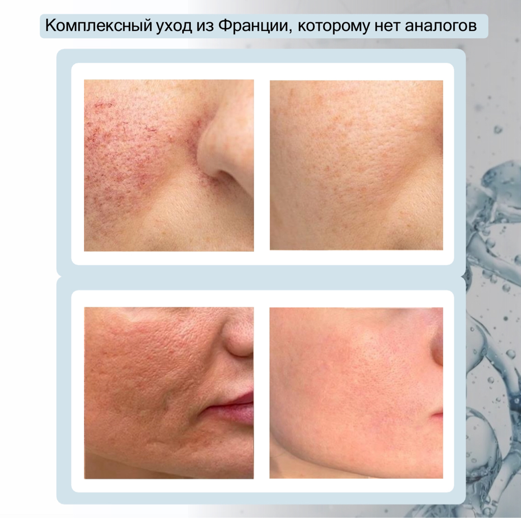 4в1  ЖИДКИЙ ЛАЗЕР  +МИКРОТОКИ+МАСКА   + ПАРАФИНОТЕРАПИЯ И МАССАЖ РУК