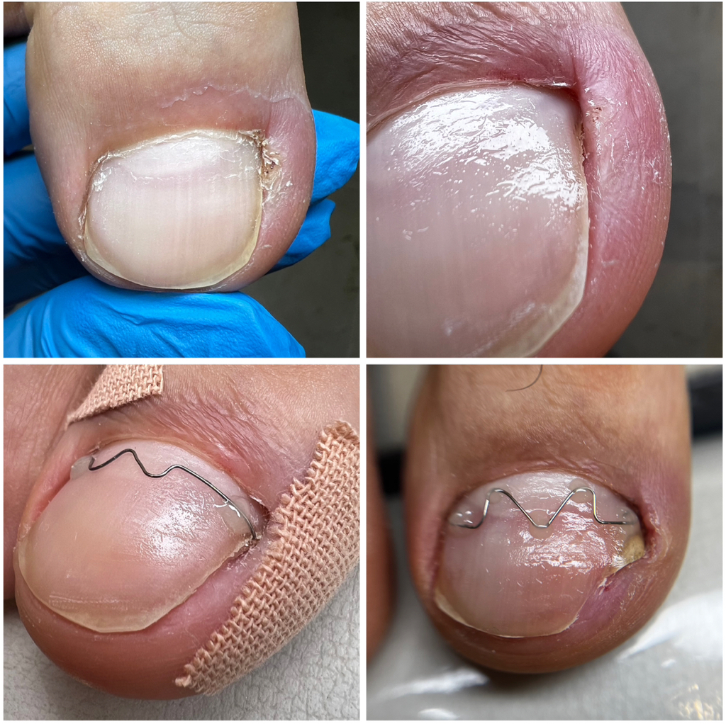 Установка коррекционной системы (большой палец)