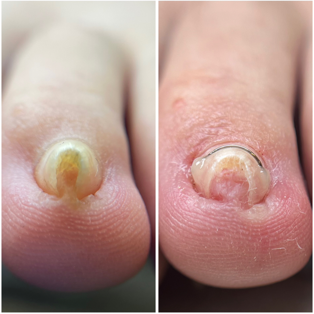 Установка коррекционной системы (маленький палец)