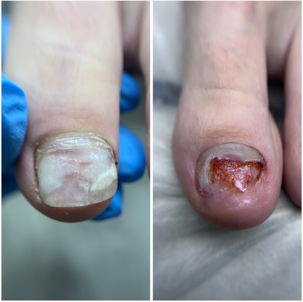 Обработка травмированного ногтя С ВОСПАЛЕНИЕМ (за единицу)