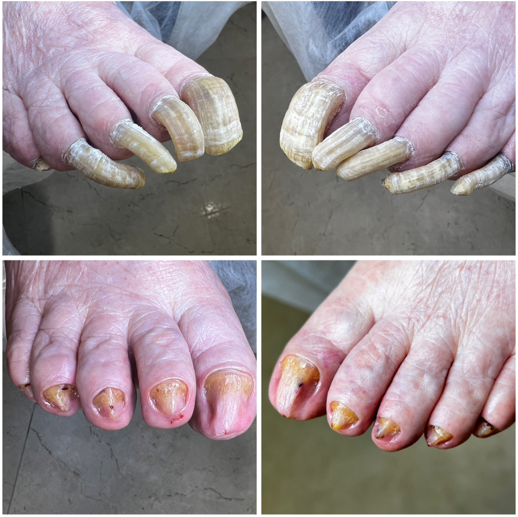 Педикюр подологический (4 степени)