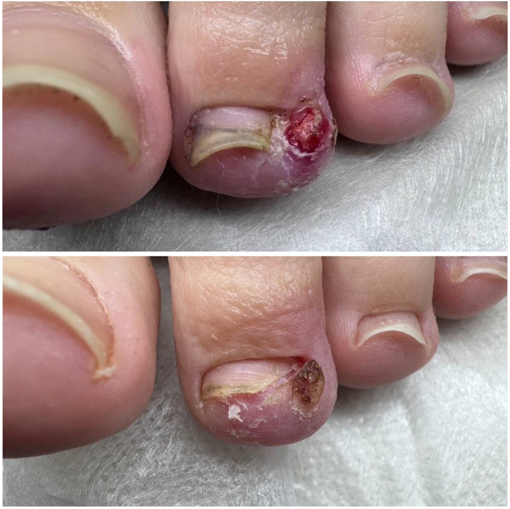 Обработка вросшего ногтя, маленький палец (ПЕРВИЧНО)