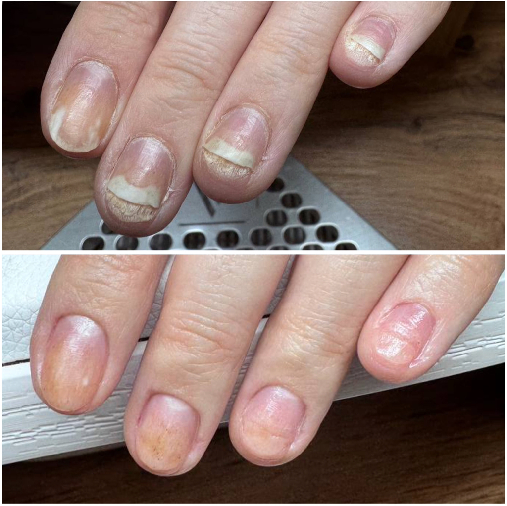 Обработка ожогов ногтевых пластин на руках (ПЕРВИЧНО)