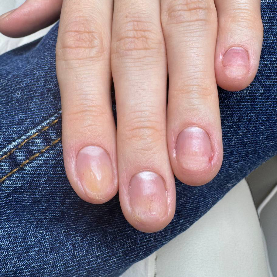 Обработка ожогов ногтевых пластин на руках (ПОВТОРНО)