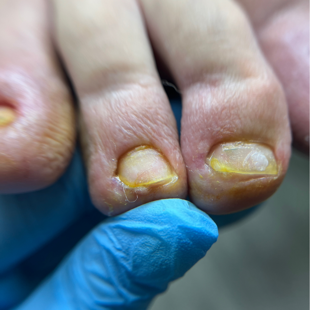 Обработка вросшего ногтя, маленький палец (ПОВТОРНО)