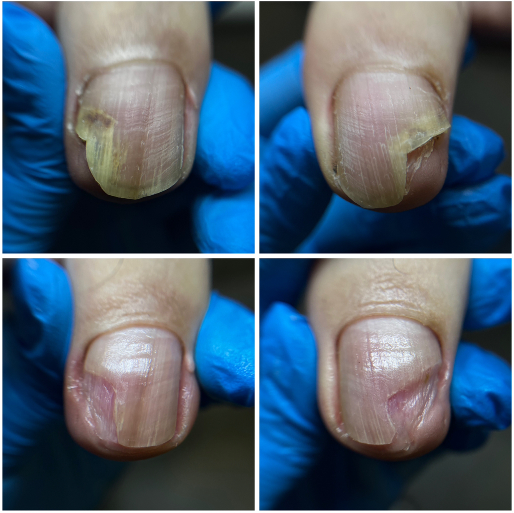 Обработка травмированного ногтя БЕЗ ВОСПАЛЕНИЯ (за единицу)