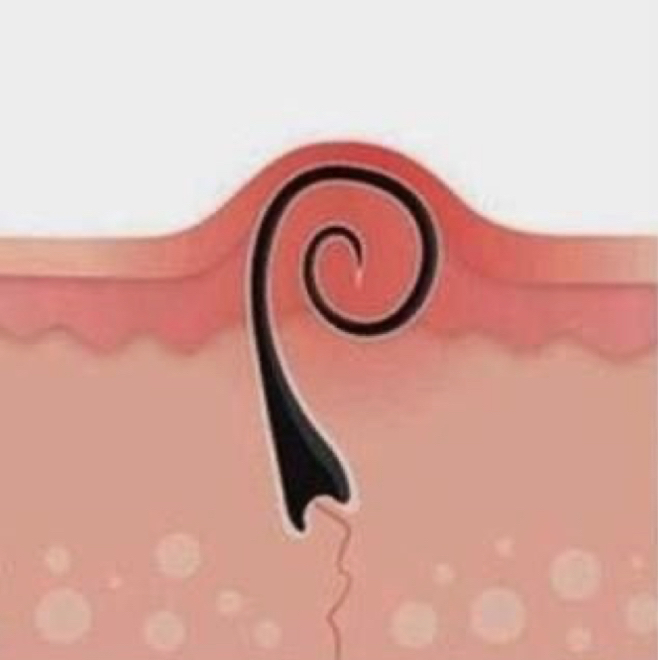 Удаление вросших волос