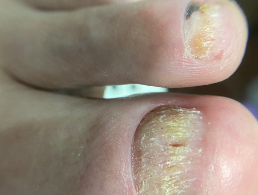 Зачистка онихомикоза