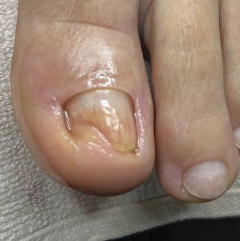 Зачистка онихолизиса/хим ожога