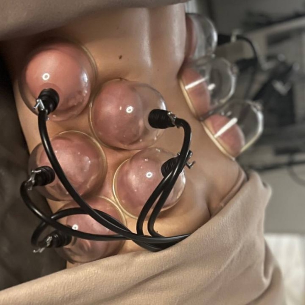 SPIDER "ПАУК" (банки с вибромассажем и липолазером )