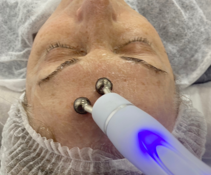 RF лифтинг лица