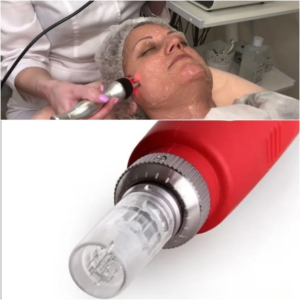 РФ лифтинг + мезотерапия ( фракционная )