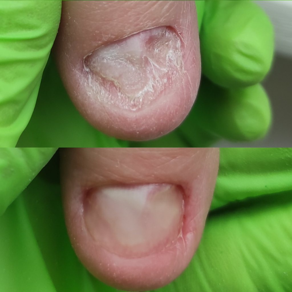 Курс "Протезирование ногтевой пластины на руках и ногах"