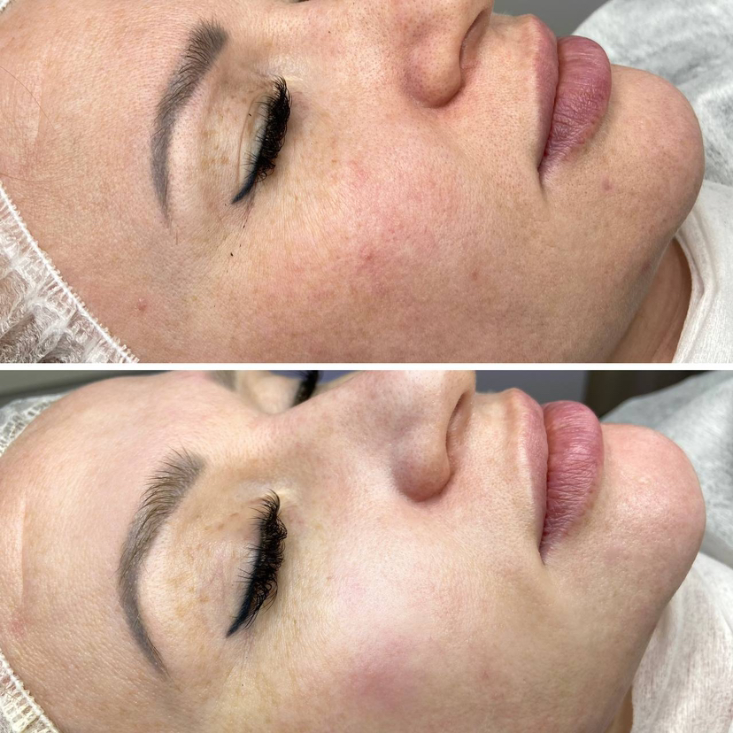 Генеральная чистка лица (чистка+пилинг+аппаратный уход)