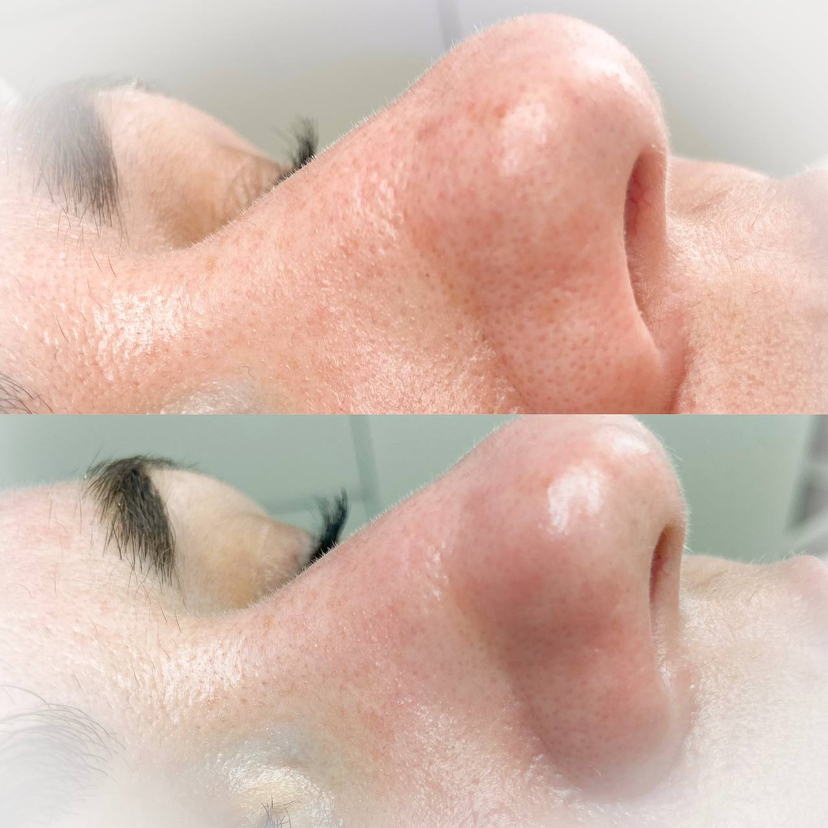 Комбинированная чистка лица