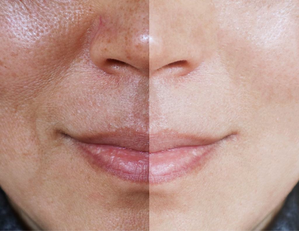 ОСВЕТЛЯЮЩИЙ ПЕПТИДНЫЙ ПИЛИНГ