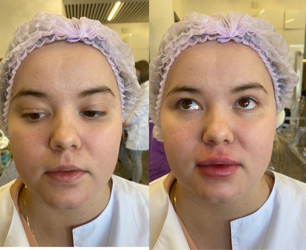 Увлажнение губ биоревитализантом