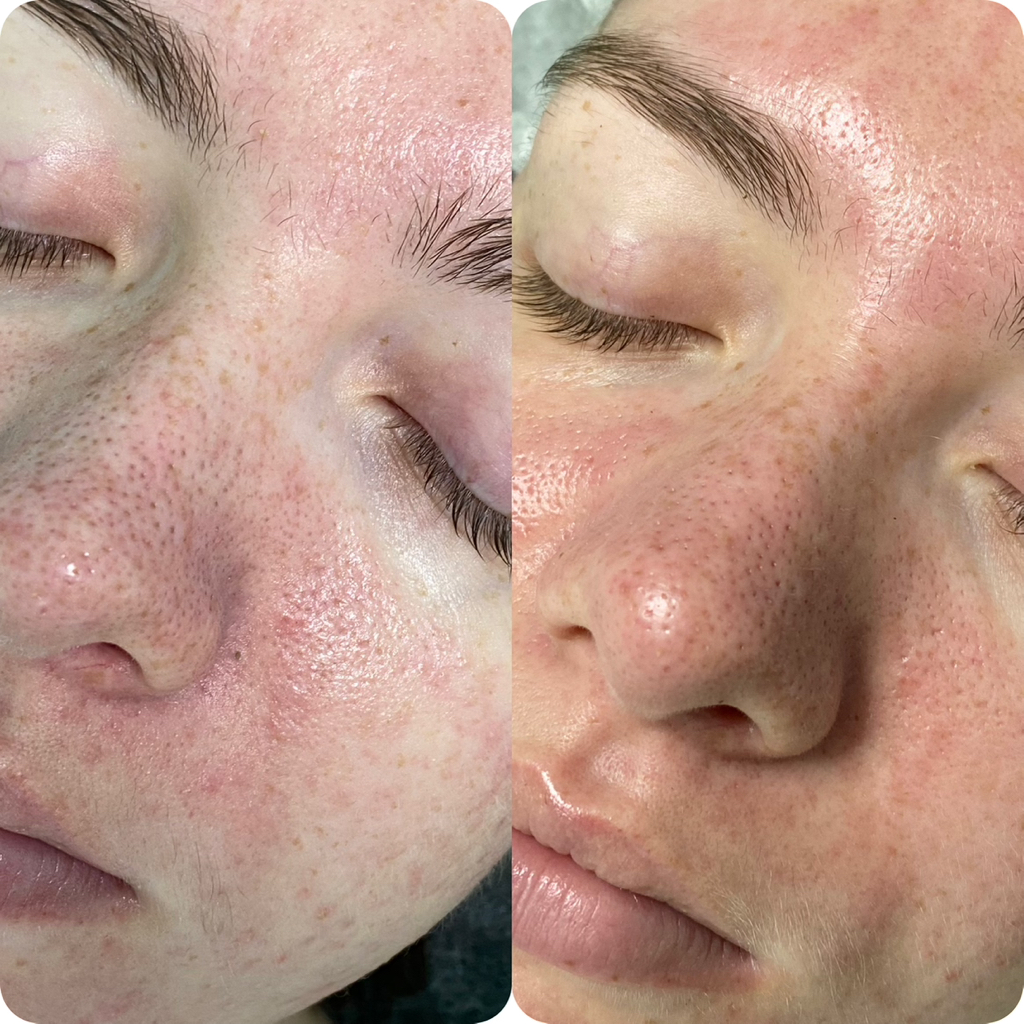 Комбинированная чистка лица