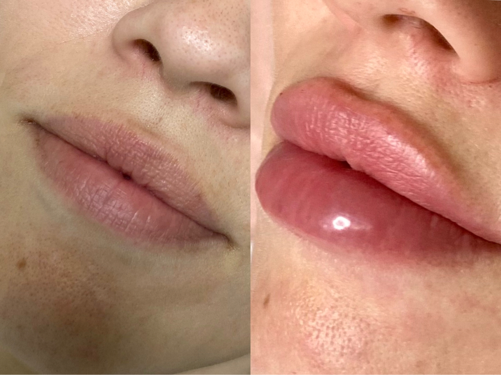 Увеличение губ филлером