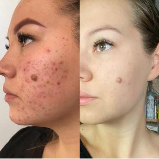 ERASER SYSTEM. ANTI ACNE