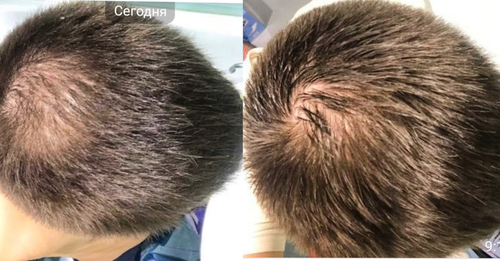 Сосудистый этап мезатерапии